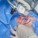 Waiting lists for cataract surgery are soaring.