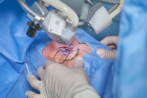 Waiting lists for cataract surgery are soaring.