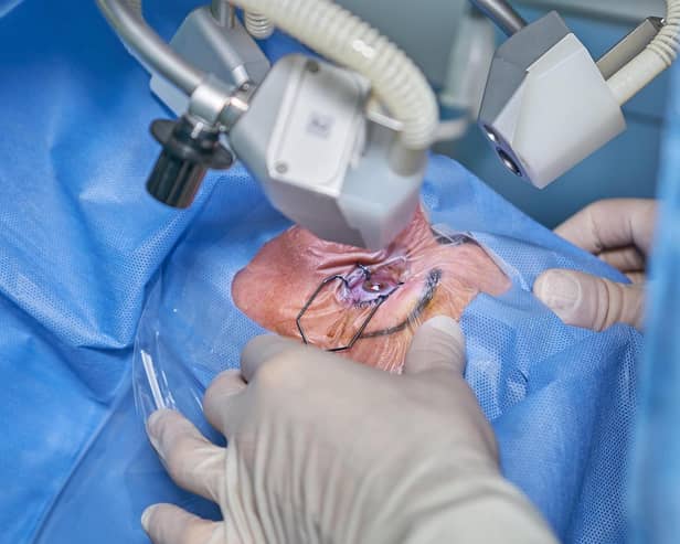 Waiting lists for cataract surgery are soaring.