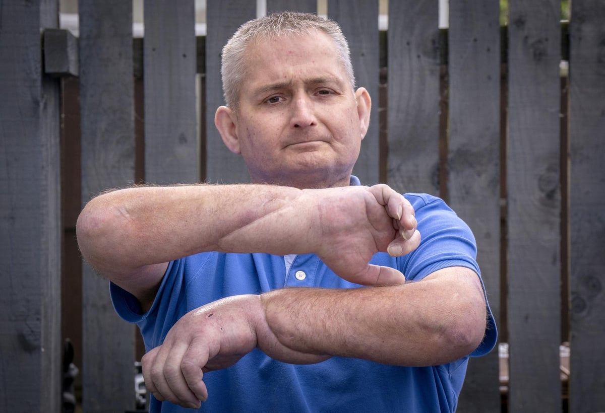 World first double hand transplant for Scottish man living with autoimmune disease