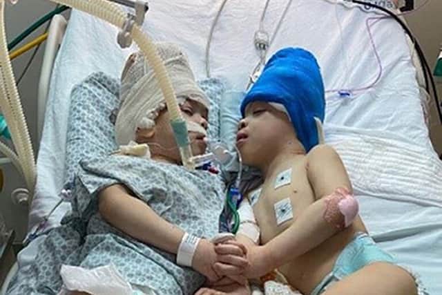 Brazilian twins Bernardo (left) and Arthur Lima who have successfully separated. Picture: Gemini Untwined/PA Wire