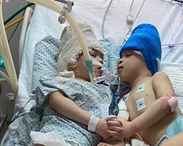Brazilian twins Bernardo (left) and Arthur Lima who have successfully separated. Picture: Gemini Untwined/PA Wire