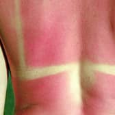 Sunburn is painful, unsightly - and can also cause serious long term health problems.