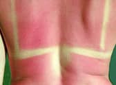 Sunburn is painful, unsightly - and can also cause serious long term health problems.