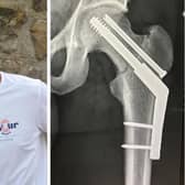 Mark Baxter, 33, was told by Edinburgh Royal Infirmary staff he was the youngest person they’d ever treated with a broken hip