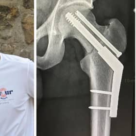 Mark Baxter, 33, was told by Edinburgh Royal Infirmary staff he was the youngest person they’d ever treated with a broken hip
