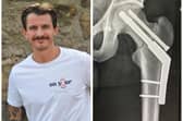 Mark Baxter, 33, was told by Edinburgh Royal Infirmary staff he was the youngest person they’d ever treated with a broken hip