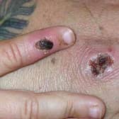 Monkeypox causes a rash which goes through different stages before finally forming a scab