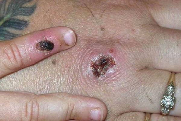 Monkeypox causes a rash which goes through different stages before finally forming a scab