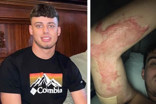 Jordan MacKenzie shows some of the injuries he sustained after being buried in concrete (Pics: Jordan MacKenzie)