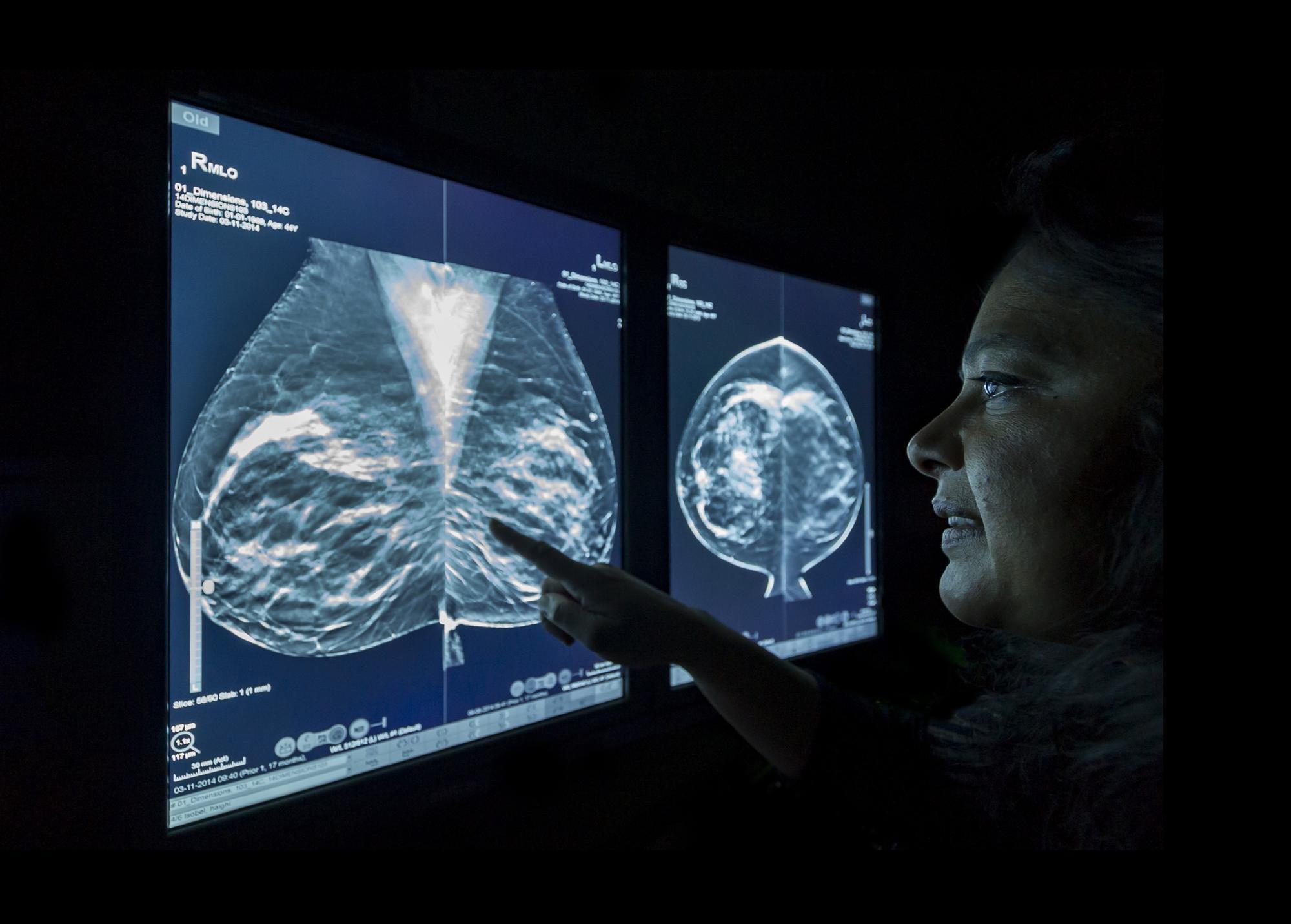 Breast cancer: Most early-stage cancer patients will become long-term survivors, study shows - Vimarsana News