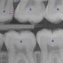 AssistDent works by using machine-learning algorithms to analyse x-rays and highlight or confirm areas of concern. Picture: contributed.