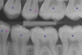 AssistDent works by using machine-learning algorithms to analyse x-rays and highlight or confirm areas of concern. Picture: contributed.