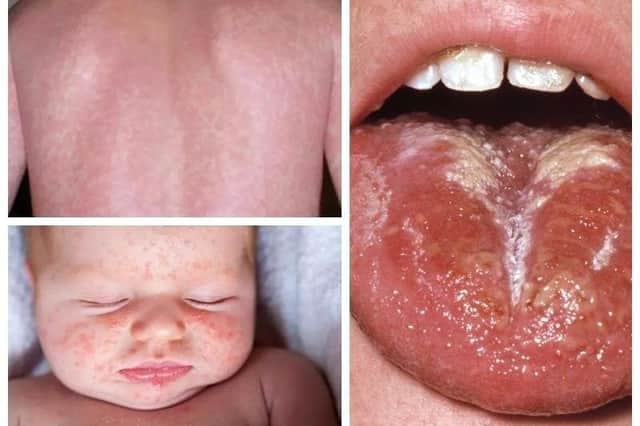 These are some symptoms of scarlet fever, which can be caused by strep A bacteria (Picture: NHS)