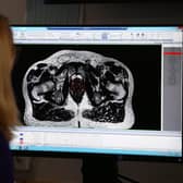 A consultant clinical oncologist examines a scan showing inside the body of a 65-year-old man diagnosed with prostate cancer (Picture: Yui Mok/PA)