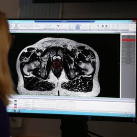 A consultant clinical oncologist examines a scan showing inside the body of a 65-year-old man diagnosed with prostate cancer (Picture: Yui Mok/PA)