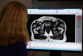 A consultant clinical oncologist examines a scan showing inside the body of a 65-year-old man diagnosed with prostate cancer (Picture: Yui Mok/PA)