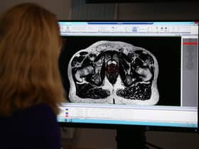 A consultant clinical oncologist examines a scan showing inside the body of a 65-year-old man diagnosed with prostate cancer (Picture: Yui Mok/PA)