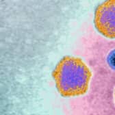 Adenovirus (highly contagious virus), responsible for: Colds, pharyngitis, bronchitis, pneumonia, gastroenteritis, conjunctivitis and keratitis. 
(Photo by: Cavallini James/BSIP/Universal Images Group via Getty Images)
