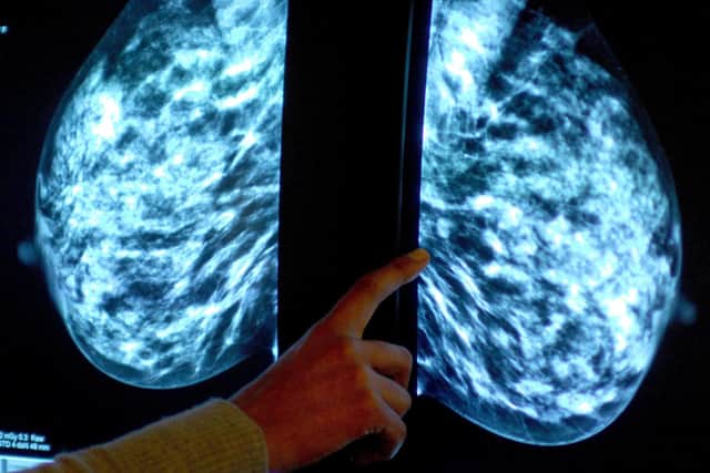 Artificial intelligence is being used to better detect breast cancer. Picture: PA