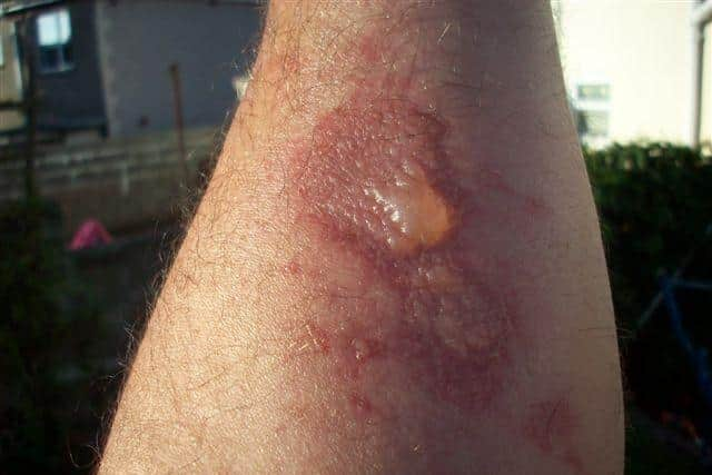 Giant hogweed sap contains a toxic chemical which causes skin to become sensitive to sunlight and results in nasty blisters and burns that can be serious and long-lasting. Picture: Tom Richards/Wye and Usk Foundation