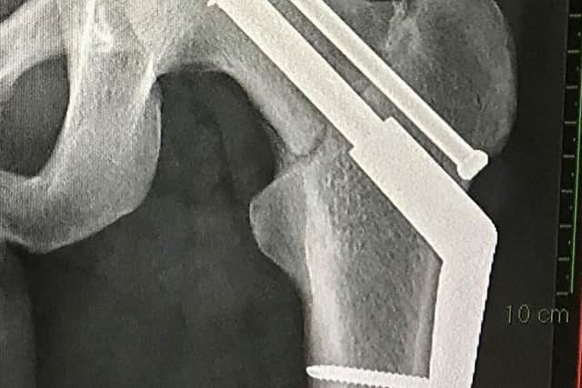 An x-ray of Mark Baxter's hip, post-surgery. Mark will now attempt to run the New York marathon in November.