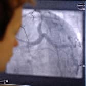 File picture of a surgical monitor showing heart arteries during angiogram procedure