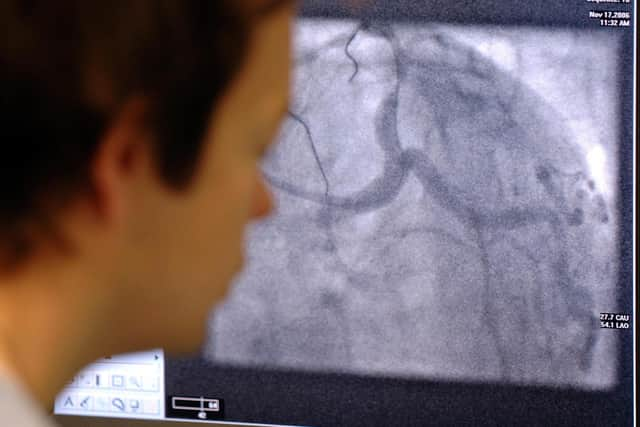 File picture of a surgical monitor showing heart arteries during angiogram procedure