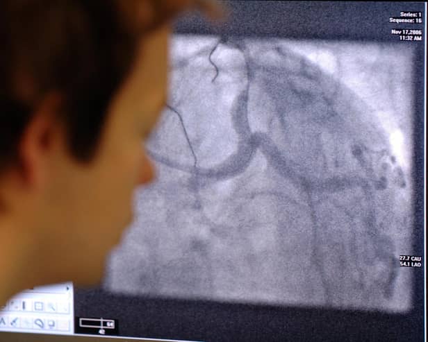 File picture of a surgical monitor showing heart arteries during angiogram procedure
