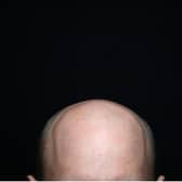 Bald men more likely to get hospitalised with Covid claims new study