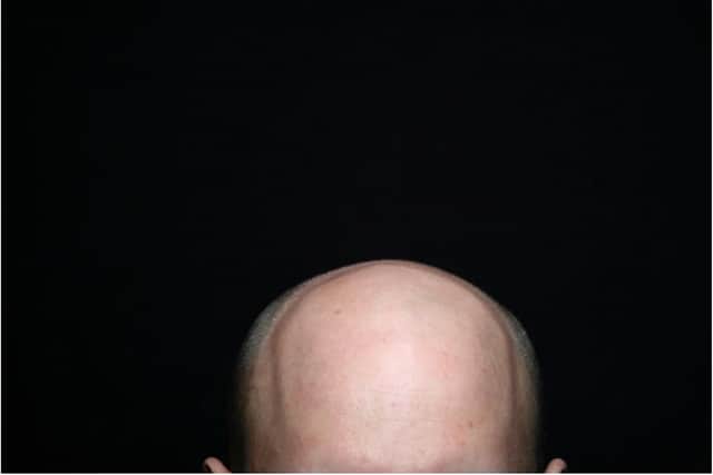 Bald men more likely to get hospitalised with Covid claims new study