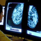 Scientists at Glasgow University believe the immune system holds the key to new treatment for breast cancer - and can help stop the spread of the disease. PIC: PA.