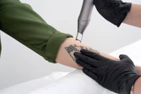 A beautician uses a laser device to remove an unwanted tattoo