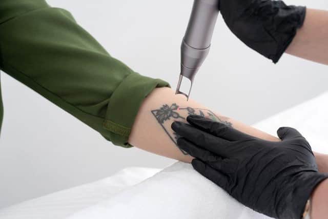 A beautician uses a laser device to remove an unwanted tattoo