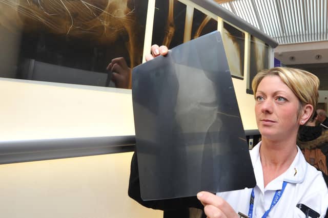 The new drug offers hope to sufferers of osteoporosis