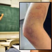 The EIS published a photo of a teacher's arms bruised after an attack (Pics: giovannacco/Pixabay & Fife EIS)