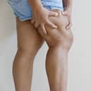 Throbbing or cramping pain, swelling, redness and warmth in a leg or arm is the main symptom of a blood clot (Photo: Shutterstock)