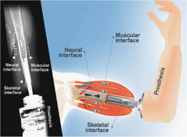The new bionic arm could be available within 2 years
