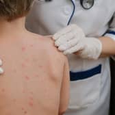 The Joint Committee on Vaccination and Immunisation has recommended the chickenpox vaccine to children aged 12 months to 18 months