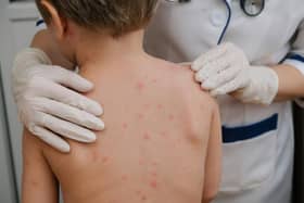 The Joint Committee on Vaccination and Immunisation has recommended the chickenpox vaccine to children aged 12 months to 18 months