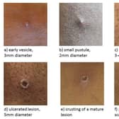 Undated handout file image issued by the UK Health Security Agency of the stages of Monkeypox. Monkeypox could have a "massive impact" on access to sexual health services, a top doctor has warned. Issue date: Saturday May 21, 2022.