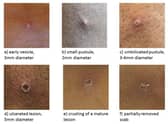 Undated handout file image issued by the UK Health Security Agency of the stages of Monkeypox. Monkeypox could have a "massive impact" on access to sexual health services, a top doctor has warned. Issue date: Saturday May 21, 2022.