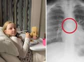 Child makes 'miraculous' recovery after swallowing battery then throwing it up in hospital
