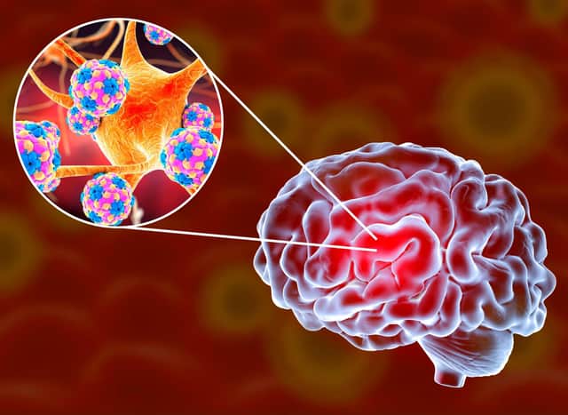 If polio infects cells in the Central Nervous System, it can then replicate in motor neurons in the brain stem.