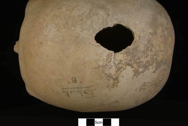 A skull, probably that of an elderly woman, from Orkney  which shows blunt force trauma to the head. Such injuries were caused by maces and curved stone balls - weapons of power and usually the size of a tennis ball, during the Neolithic period.