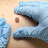 A doctor examines a mole for the presence of skin cancer