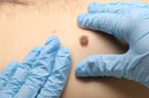 A doctor examines a mole for the presence of skin cancer