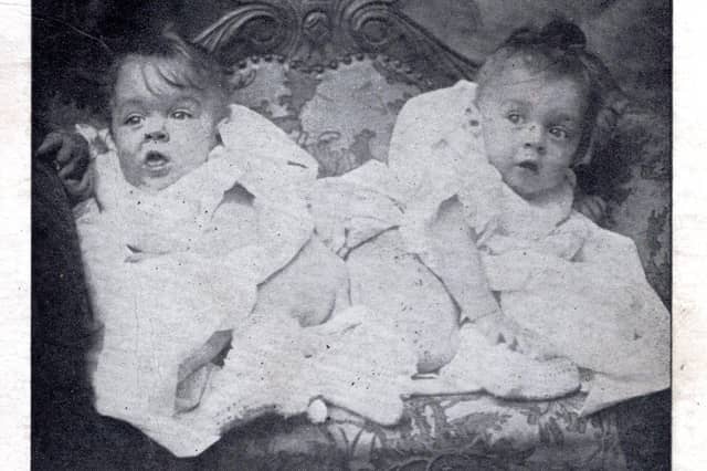 The Brighton United Twins, conjoined sisters
