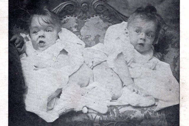 The Brighton United Twins, conjoined sisters