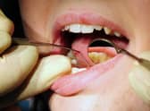 Research by the British Dental Association shows that 59% of dentists questioned had reduced the amount of work they carry out on the NHS. Pic: Rui Vieira/PA Wire